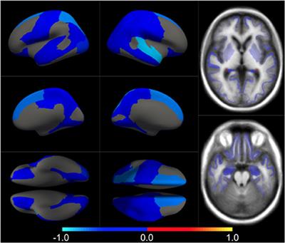 Projection to Latent Spaces Disentangles Pathological Effects on <mark class="highlighted">Brain Morphology</mark> in the Asymptomatic Phase of Alzheimer's Disease